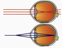 你对近视眼手术了解多少？