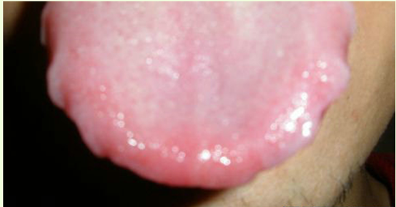 舌头上有齿痕是什么征兆，是身体抱恙的反馈吗？
