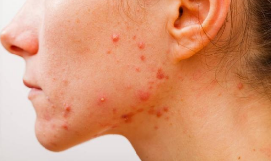 皮肤过敏的有哪些急救方法？